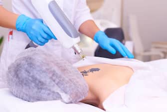 Laser tattoo removal in a cosmetology clinic.