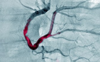 Myocardial infarction with a significant thrombus in the right coronary artery and extends into the left retro ventricular and the posterior interventricular artery. Coronary angiography. (Photo by: CAVALLINI JAMES/BSIP/Universal Images Group via Getty Images)