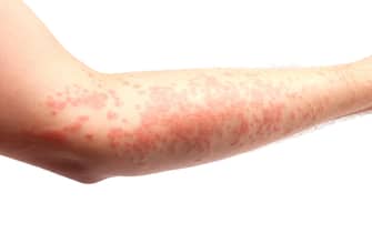 arm covered in a skin allergy,hives