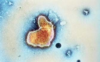 virus sinciziale bambini