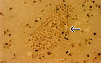 A section of the brain of a patient with primary amoebic meningoencephalitis stained with hemotoxylin and eosin showing a large cluster of Naegleria.