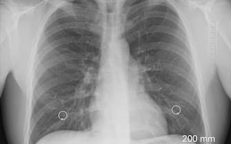 Radiografia a un polmone