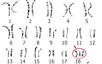 Edwards syndrome karyotype