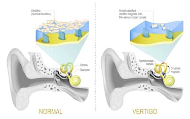 Benign paroxysmal positional vertigo. BPPV. labyrinth of the inner ear with Semicircular canals. Comparison between Normal vestibular system and Vertigo when Small calcified otoliths migrate from Saccule and Utricle into the semicircular canals. Vector illustration