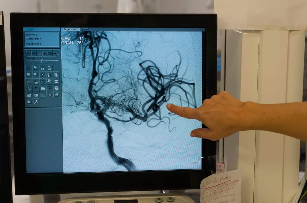 Salute, ictus: i 6 campanelli d’allarme da non ignorare e le regole per prevenirlo