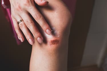 Abrasion on the woman's knee. Girl is applying cream on the injured leg with a red wound. Medical treatment for first aid.