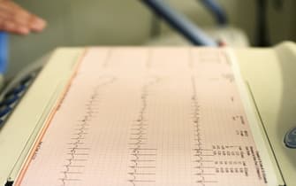 Electrocardiogram recording of patients cardiac cycle produced by electrocardiograph (Photo by Universal Images Group via Getty Images)