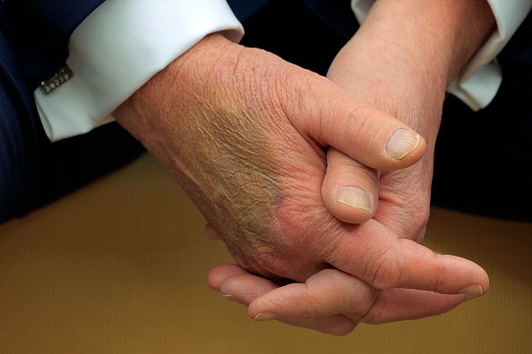 2201770965 WASHINGTON, DC - FEBRUARY 24: Makeup covers a bruise on the back of U.S. President Donald Trump's hand as he hosts French President Emmanuel Macron for meetings at the White House on February 24, 2025 in Washington, DC. Macron is meeting with Trump in Washington on the third anniversary of Russia's full-scale military invasion of Ukraine. (Photo by Chip Somodevilla/Getty Images)
