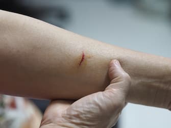 Asian woman's arm was cut by a sharp object, bleeding. knife cut