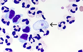 A fixed cerebrospinal fluid cytospin showing a Giemsa-Wright stained Naegleria fowleri trophozoite (arrow) amid polymorphonuclear leukocytes.