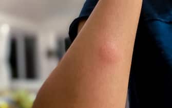 red swollen mosquito bite on young mixed-race female’s arm