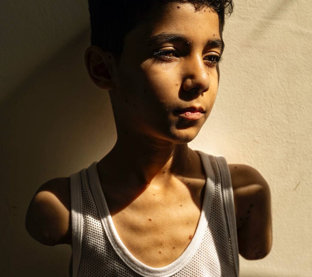 World Press Photo of the Year 2025 | Samar Abu Elouf - Mahmoud Ajjour, Aged Nine | World Press Photo