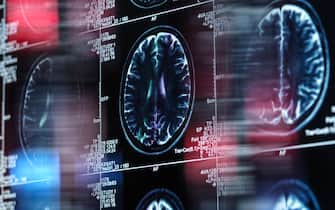 Alzheimer's and dementia research, conceptual image. Magnetic resonance imaging (MRI) scan of a human brain on a screen