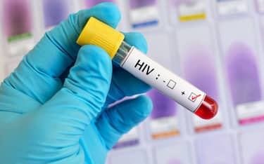 Blood sample positive with HIV test