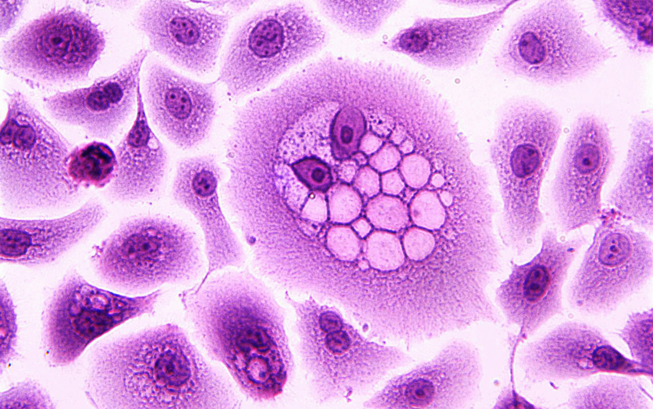 A koilocyte is a squamous epithelial cell that has undergone structural changes as a result of infection by human papillomavirus (HPV). This image of a koilocyte shows human ectocervical cells (HEC) expressing HPV-16 E5 oncoprotein, and immortalized with HPV-16 E6 and E7 oncoproteins. Formation of koilocytes requires cooperation between HPV E5 and E6 oncoproteins. The cell culture is stained with hematoxylin and eosin (H&E).