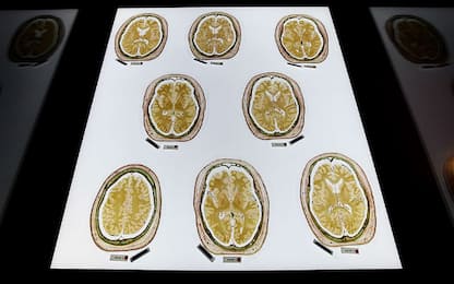 Tumore cerebrale infantile, forse una nuova cura per i medulloblastoma