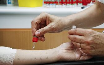 Allergology department of Saint-Vincent de Paul hospital, GHICL, Lille. Food Allergies, Prick test using reference allergens, on a boy's skin. (Photo By BSIP/Universal Images Group via Getty Images)