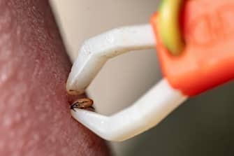 epa10596367 A macro photograph of a person using tweezers to grasp and remove a tick from his skin, in Herrnleis, Lower Austria, Austria, 28 April 2023. Ticks, parasitic arachnids, are more active in the warmer seasons and live by feeding on the blood of their hosts. Tick-borne pathogens can be passed to humans by the bite of infected ticks with bacteria, viruses, or parasites. Some of the most common tick-borne diseases include tick-borne encephalitis (TBE) and borreliosis (Lyme disease).  EPA/CHRISTIAN BRUNA