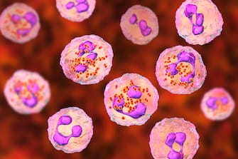 Meningococcal meningitis. Computer illustration showing cerebrospinal fluid containing numerous neutrophils with Neisseria meningitidis bacteria inside (small red bean-shaped diplococci, incomplete phagocytosis).