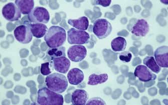Leukemia; myeloid, 250X at 35mm. This type of leukemia has its origin in the bone marrow (myeloid tissue). It involves a malignant proliferation of immature white blood cells. This action can crowd out production of RBC s and platelets leading to anemia and thrombocytopenia.