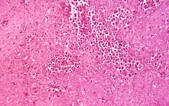 Under a magnification of 125X, this photomicrograph of a brain tissue specimen depicts the cytoarchitectural changes associated with a free-living, Naegleria fowleri, amebic infection. When free-living amebae infect the brain or spinal cord, the condition is known as primary amebic meningoencephalitis, or PAM. Free-living amebae belonging to the genera Acanthamoeba, Balamuthia, and Naegleria are important causes of disease in humans and animals, though only one specie of Naegleria, Naegleria fowleri, causes disease in humans. See PHIL 3412, or click the link below, for an illustrative depictio