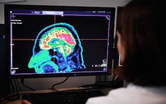 A picture of a human brain taken by a positron emission tomography scanner, also called PET scan, is seen on a screen on January 9, 2019, at the Regional and University Hospital Center of Brest (CRHU - Centre Hospitalier RÃ©gional et Universitaire de Brest), western France. - The CHRU of Brest has just acquired a new molecular imaging device, the most advanced in France today according to the hospital center, capable of better detecting deep lesions and especially cancerous pathologies, the hospital announced on January 9, 2019. (Photo by Fred TANNEAU / AFP) (Photo by FRED TANNEAU/AFP via Getty Images)