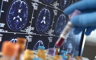 United Kingdom, High Wycombe, Alzheimer's and Dementia Research, Scientist holding a blood sample during a clinical trial with a MRI on screen