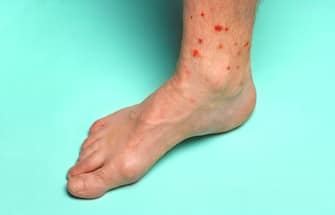 Adult man's naked foot covered with red raw insect bites