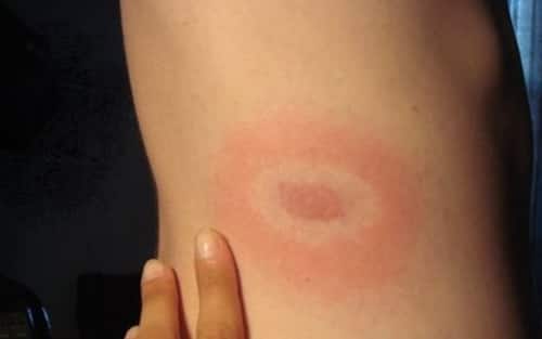 Morso Zecca Lyme