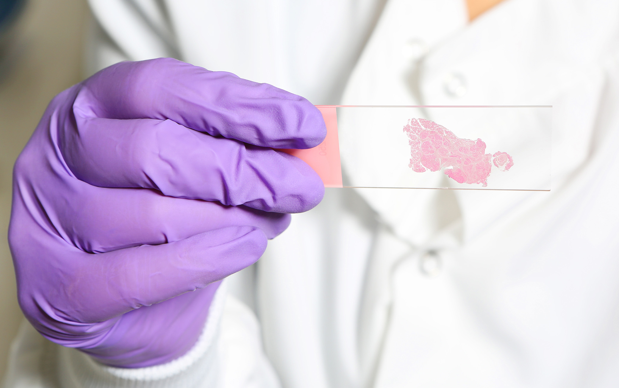 Female scientist showing a glass slide that has a sample from a great tumour on it.