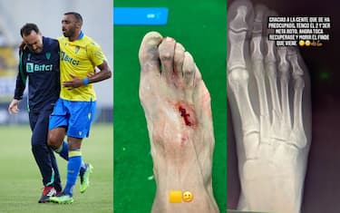 Akapo si rompe il piede: foto choc sui social