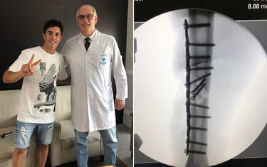 Marquez, sui social le foto del braccio fratturato