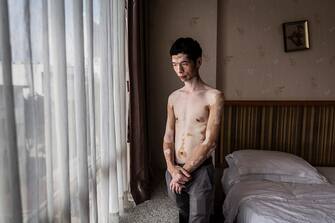 CANTON, CHINA - 2019 MAY 26: LU, posing in my hotel room. He is 34 years old and he had the first Vitiligo spots when he was 12 on the back and on the knees. When he was 24 his skin problem increased quickly on all his body without an apparent reason. He got vitamins and Chinese medicine and his melanine was coming back.The work stress is getting worse and worse his Vitiligo . In the last 10 years his mum is suffering of Vitiligo too. She has many marks on her arms and her belly
