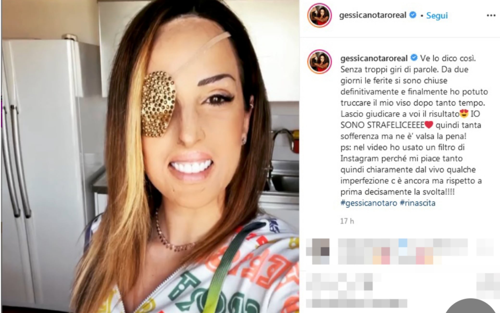 Gessica Notaro Su Instagram Felice Dopo Gli Interventi Di Chirurgia Sky Tg24