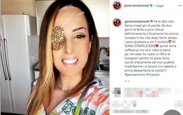 Gessica Notaro dopo gli interventi: “Sofferenza ma ne è valsa la pena”