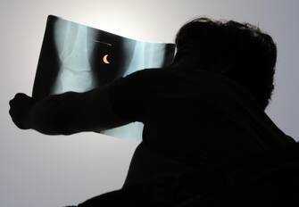 epa08499499 A man observes a solar eclipse using an X-ray film in Jammu, northern India, 21 June 2020. During this annular solar eclipse   the first of the decade   the moon appears to cover the sun, leaving the sun's halo as a visible rim forming an annulus, popularly known as the 'ring of fire.'  EPA/JAIPAL SINGH