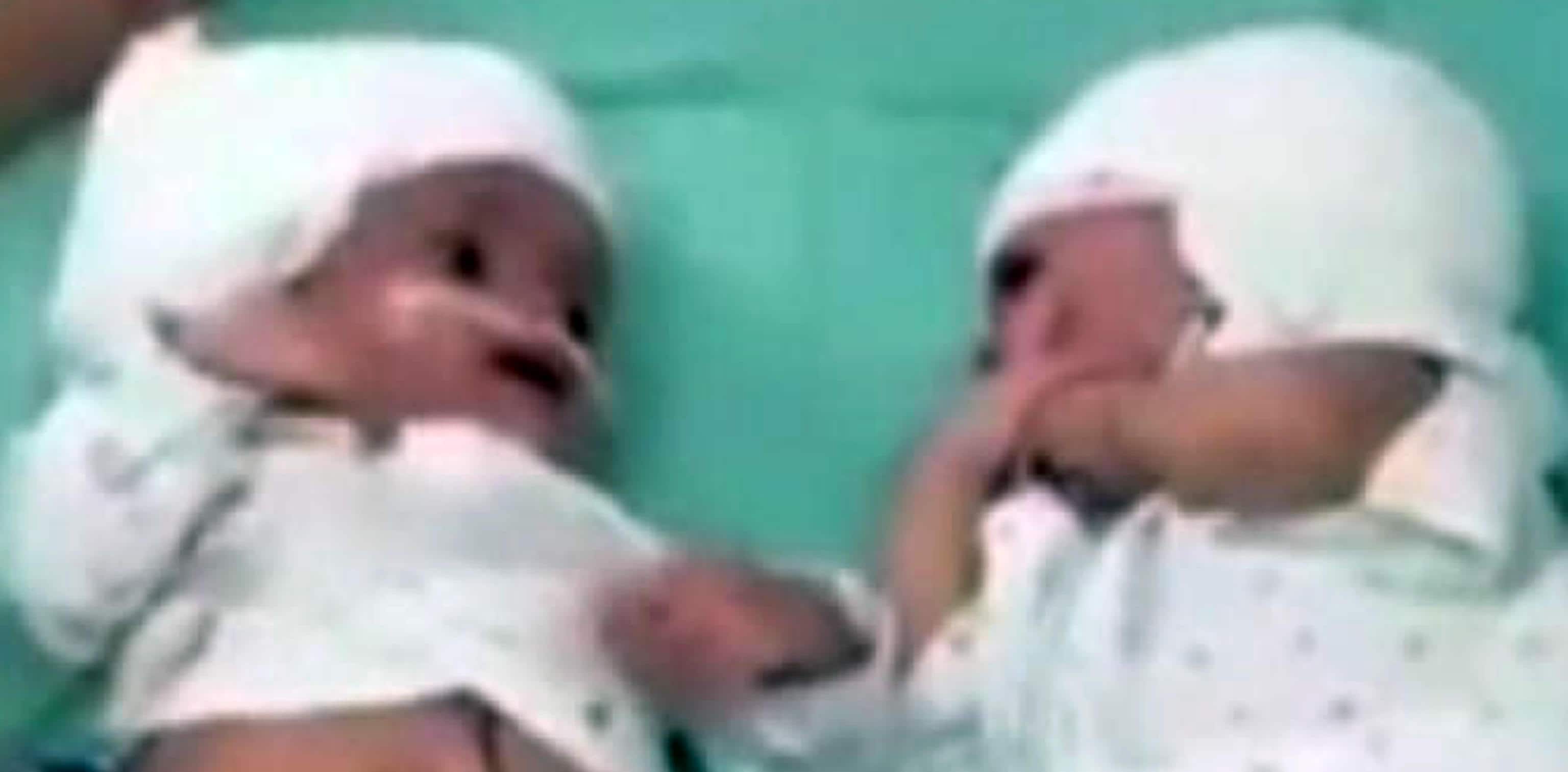 epa09451662 A frame grab made from an undated handout video made available by the Soroka Medical Centre shows the twins after their separation, at the hospital in Be'er Sheva, Israel (issued 06 September 2021). The one-year-old twins, conjoined at the back of their heads, were separated on 02 September in a 12-hours-long surgery, the Soroka University Medical Center said. The rare surgery was the first of its kind in Israel.  EPA/SOROKA MEDICAL CENTER HANDOUT BEST QUALITY AVAILABLE HANDOUT EDITORIAL USE ONLY/NO SALES