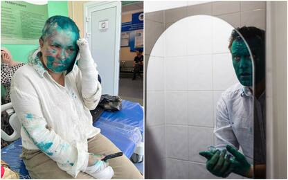 Zelyonka, la vernice verde usata per colpire gli oppositori in Russia