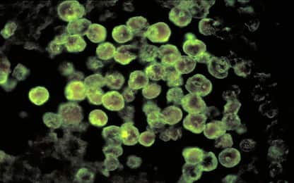 Florida, ameba mangia cervello: ragazzo sopravvive al virus letale