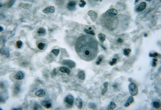 Colombia, 10-year-old girl killed by brain-eating amoeba after swimming in the pool