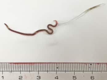 Giappone: verme parassita trovato nella tonsilla di una donna