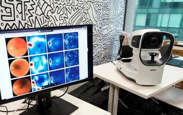 Settimana mondiale del glaucoma, la seconda causa di disabilità visiva