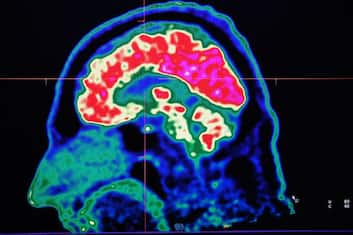 Misofonia, ecco cosa accade nel cervello di chi ne soffre: lo studio