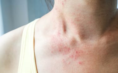 Young woman has skin rash itch on neck