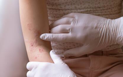 Primo caso di naturalizzazione edera velenosa: può provocare dermatiti