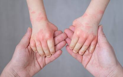 Il 29 ottobre si celebra la Giornata mondiale della psoriasi