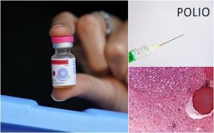 Poliomielite a Londra e New York, sintomi e vaccini: cosa sapere