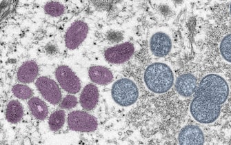 Digitally-colorized electron microscopic (EM) image depicting a monkeypox virion (virus particle), obtained from a clinical sample associated with a 2003 prairie dog outbreak, published June 6, 2022. The image depicts a thin section image from a human skin sample. On the left are mature, oval-shaped virus particles, and on the right are the crescents and spherical particles of immature virions. Courtesy CDC/Goldsmith at al. (Photo via Smith Collection/Gado/Getty Images)