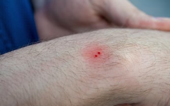 Male hand with the wound from snake bite or snakebite. Bite marks with blood drops and red skin. Closeup, selective focus