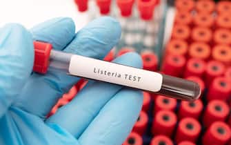 Hand holding a glass of test tube with patient's blood for testing Listeria bacteria